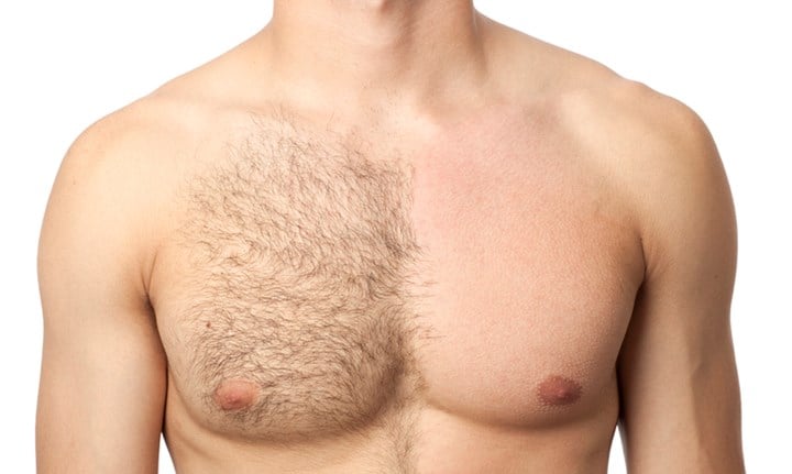 male laser hair removal