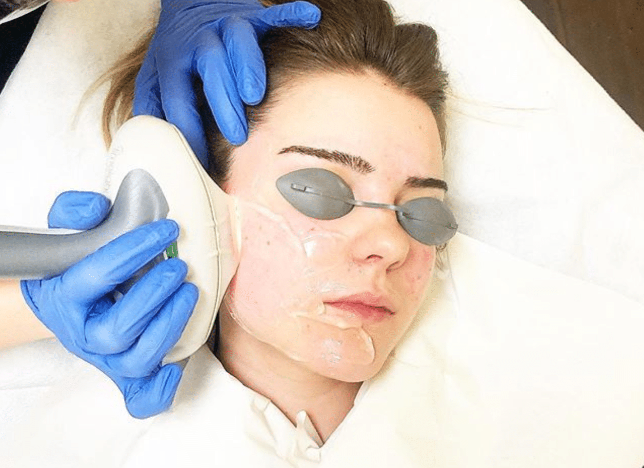 Types of Laser Treatments | Spoiled Laser